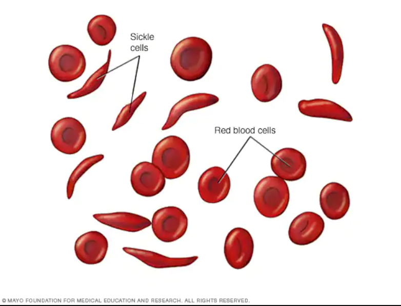 Sickle cell anemia